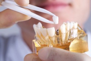 dental-implant-services